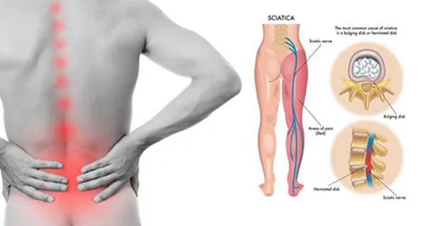 Mọi điều cần biết về đau thần kinh tọa